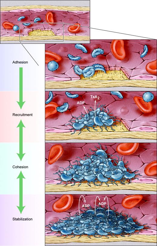 Circulating platelets are activated by newly exposed collagen fibrils and locally generated thrombin at sites of vascular injury. Using von Willebrand factor as a cofactor, platelets adhere to the vessel wall, spreading out and forming a monolayer. Additional platelets are recruited through the continued action of thrombin, as well as the release of soluble molecules such as ADP and thromboxane A2 (TxA2). As more platelets become activated, they stick to each other (cohesion), increasing the height of the thrombus. ADP supports all of these events by binding to G protein–coupled receptors on the platelet surface. The studies of Cosemans et al show that ADP is also needed for thrombus stability, helping to protect it from premature dissolution. Illustration by Kenneth Probst.