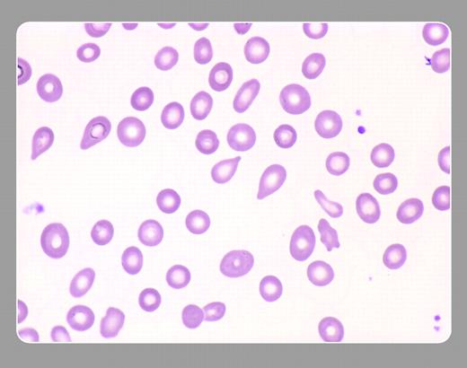 Figure 1. These abnormal erythrocytes have a teardrop, or pearlike, shape. They are associated with disorders with an abnormal spleen or bone marrow, such as idiopathic myelofibrosis, thalessemia, or myelophthisis. . / Peter Maslak, Memorial Sloan-Kettering Cancer Center