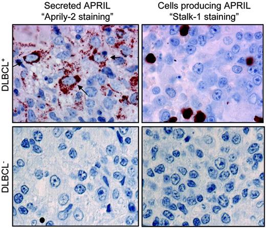 Figure 1. APRIL is strongly expressed in DLBCL lesions. DLBCL tumor lesions were stained with Aprily-2 (left) and Stalk-1 (right). Representative tumor lesions with high (top) and low (bottom) expression of APRIL are shown. Original magnification was × 63. Concentration of the Aprily-2 staining on cells with a morphology reminiscent of DLBCL was marked with an arrow.