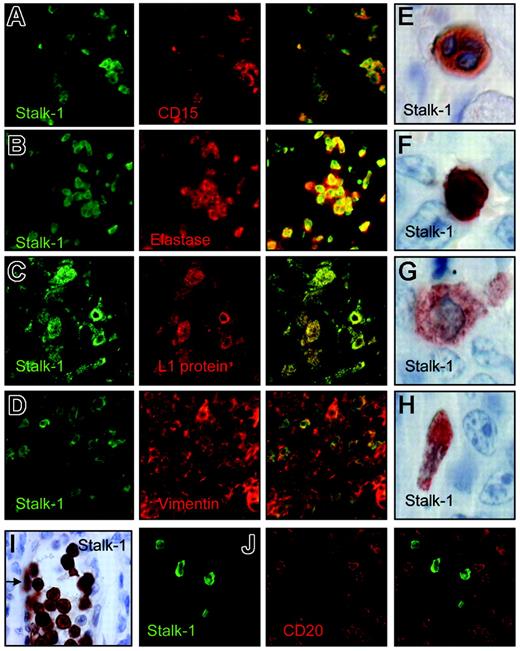 Figure 3. APRIL is produced mainly by neutrophils infiltrating DLBCL lesions. Stalk-1 staining (green) was combined to (A) anti-CD15 (1 of 50), (B) antielastase (1 μg/mL), (C) anti-L1 protein (10 μg/mL), and (D) antivimentin (5 μg/mL) stainings (all in red). Single stainings and corresponding merge pictures shown are representative of 2 or more patients with DLBCL. (E) Morphology of Stalk-1–stained cells. (F-H) Intensity of Stalk-1 staining is shown for a cell with a morphology of (F) a neutrophil, (G) a histiocyte, and (H) a mesenchymal cell from the same lesion. The pictures were taken with the same exposure time. (I) The picture shows endothelial cells lining tumor-draining vessels (arrow) and blood neutrophils stained with Stalk-1.(J) Stalk-1 staining (green) was combined to anti-CD20 staining (red, 5 μg/mL) and analyzed by confocal microscopy. Single stainings and corresponding merge picture are representative of 6 patients with DLBCL.