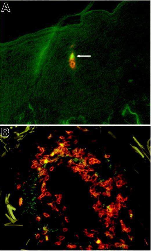 Figure 3. FOXP3+ Tregs are resident in healthy human skin. Sections of healthy human skin were costained with directly conjugated antibodies to CD3 (red) and FOXP3 (green). FOXP3+ Tregs were clearly visible as cells with red membranes and green nuclei. (A) Two T cells present within the epidermis are shown, 1 regulatory (white arrow) and 1 nonregulatory. In general, Tregs were found in the same locations as non-Tregs, located near blood vessels and appendages within the dermis. (B) A particularly brisk infiltrate of T cells containing Tregs surrounding a blood vessel. Such infiltrates can be characteristic of normal human skin.