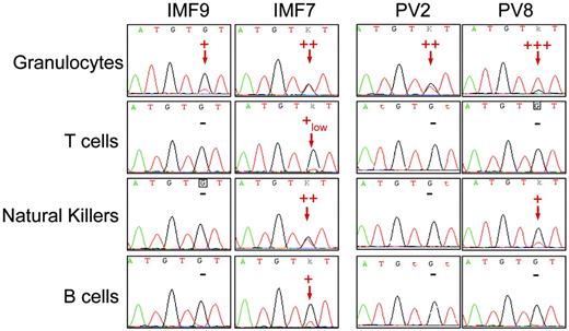 Figure 1. Detection of the JAK2 G1849T mutation in peripheral lymphoid cells from IMF and PV patients. Peripheral granulocytes and lymphocytes from JAK2-mutated IMF and PV patients were isolated using standard density, immunomagnetic, and flow cytometric methods for further DNA extraction and sequence analysis. The JAK2 G1849T mutation was detected in some lymphoid cells from a majority of IMF patients and a minority of PV patients. The sequence traces of granulocytes and T, NK, and B cells from 2 IMF (patients IMF9 and IMF7) and 2 PV patients (patients PV2 and PV8) are shown; – indicates that the mutation was not detected. Red arrows indicate the presence of a mutant peak. Semiquantitative estimate of the percentage of mutated allele is presented on each sequence trace.