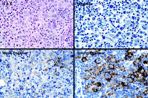 Figure 1. HGAL protein expression in classic Hodgkin lymphoma. The spectrum of HGAL staining in cHL cases is shown. Staining is localized to the cytoplasm of large atypical cells. Staining in more than 5% but less than 30% of Hodgkin cells was defined as weak, whereas staining in 30% or more Hodgkin cells was defined as strong.