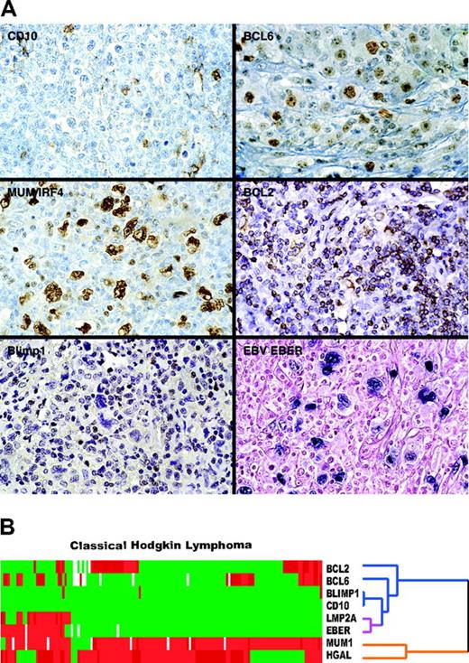 Figure 2. Representative immunostains and EBV expression in classic Hodgkin lymphoma. (A) Typical examples of TMA cores of cHL stained for BCL6, CD10, BCL2, MUM1/IRF4, and Blimp1 and in situ hybridization for EBV EBER RNA are shown. (B) Hierarchic cluster analysis of immunohistologic and in situ hybridization data shows that HGAL clusters with MUM1/IRF4 on 1 branch of the dendrogram (orange) but not with BCL2, CD10, and BCL6 (blue) or with the 2 EBV-specific markers, LMP2A and EBER (purple), which cocluster with each other.