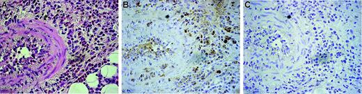 Figure 2. Immunohistochemical analysis of DDR1 expression in the biopsied tissue of a CSS patient. Original magnification, × 350. (A) Hematoxylin-eosin staining. (B) Stained with the DDR1 antibody. (C) Negative control for the DDR1 antibody. Cells were stained with hematoxylin. Images were captured with an Olympus U-PMTVC microscope (Olympus, Tokyo, Japan) with a UPlan Apo 20×/0.80 NA objective lens, and an Olympus DP11-N. Images were captured with Adobe Photoshop 7.0 (Adobe Systems, San Jose, CA).