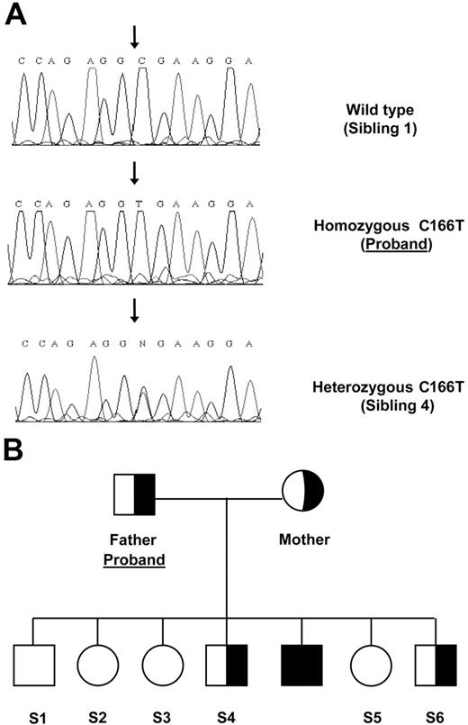 Figure 1. Family tree and mutation. (A) Sequence chromatographs of the HAMP gene region spanning the C166T mutation (forward sequence show) from the indicated individuals. (B) Pedigree of family carrying the R56X.