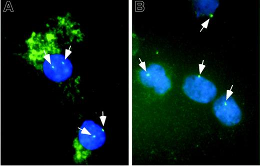 Figure 4. Immune cytochemical and FISH analyses of monocytes. CD14+ cells from a healthy donor (A) and a patient with a deletion of chromosome 7 in the MDS clone (B) were cultured in the presence of HS5 CM for 5 days then spun onto glass slides and labeled with REGA-2D9 monoclonal antibody against MMP-9 revealed with an HRP-conjugated secondary antibody and Vector SG peroxidase substrate. The cells were then probed for chromosome 7 by FISH. Green dots in the nuclei represent the FISH signal of chromosome 7 (indicated by white arrows). Positive staining of MMP-9 is detected as green fluorescence in the cytoplasm as a result of autofluorescence of the peroxidase substrate. Nuclei are counterstained with DAPI (blue). The images were captured and flattened prior to leveling contrast and brightness. Original objective × 100.
