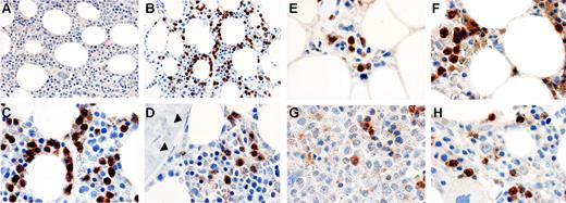 Figure 6. Immune cytochemical detection of MMP-9 protein in bone marrow. Bone marrow biopsies from a healthy donor (A-D) or MDS patients (E-H) were fixed in B5 fixative, antigen-retrieved, and incubated with a monoclonal antibody against MMP-9 (clone REGA 2D9; B-H) or an isotype-matched control antibody (A). The bound antibody was detected with HRP-conjugated secondary antibodies and Vector ABC stain kit. Positive staining of MMP-9 is brown; nuclei counterstained with hematoxylin are blue. Mature myeloid cells are MMP-9+ in both the healthy donor and MDS patients. Fibroblastic cells (stroma) were negative (nuclei of the fibroblasts are indicated by arrowheads in panel D). Megakaryocytes, evident in panel H, are also negative, as are endothelial cells and blood cells in sinusoids shown in panel E. Specific patient samples shown include: E, patient no. 9; F, patient no. 20; G, patient no. 12; H, patient no. 22 (Table S1 provides patient data). The images were captured and flattened prior to leveling contrast and brightness. Original objective × 40 for panels A-B; × 100 for panels C-H.