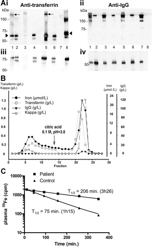 Figure 1. Analysis of the transferrin-IgG complex and ferrokinetics measurements. (A) Identification of an IgG-transferrin complex in the serum of both patients by Western blot. A 5 μL sample of diluted serum (1:1000) or 1 μg of protein A–purified proteins from the 2 patients, from 1 healthy individual, and from 1 IgG-κ myeloma were boiled in 1% SDS loading buffer without (i, ii) or with (iii, iv) 5% β-mercaptoethanol, subjected to 1% SDS–7.5% polyacrylamide gel electrophoresis, and transferred on Hybond ECL Nitrocellulose Membrane (Amersham, Saclay, France). Following blocking with 3% nonfat milk, the membrane was incubated with polyclonal anti–human transferrin (i, iii) or anti–human IgG (ii, iv) antibodies. The purified fraction (lane 1) and the serum (lane 2) of patient 1 were run in parallel with the purified fraction (lane 3) or the serum (lane 4) from a control individual, the purified fraction (lane 5) and the serum (lane 6) of patient 2, and the purified fraction from a monoclonal IgG2 (lane 7). Human transferrin (lane 8) was used as a control. The transferrin-IgG complex is indicated by an arrow and free transferrin by an arrowhead. (B) Protein A chromatography. A 300 μL serum sample from patient 2 was applied on a (5 × 0.5 cm) column packed with protein A–Sepharose 4B and eluted as indicated. IgG, transferrin, and iron were measured in the various fractions. Transferrin was in both unbound (1 to 14) and bound fractions (15 to 29). IgG was only demonstrated in the bound fractions. (C) In vivo plasma clearance of 59Fe. Radioactivity in the plasma was measured at different time intervals following injection of 59Fe-labeled autologous plasma. The reference curve established from the ferrokinetics measurement obtained for 30 healthy controls7 shows that the normal half-life is 75 minutes (range, 70-110 minutes). The half-life of the radioactivity in the patient's plasma was 206 minutes, 2.75 times longer than normal half-life.