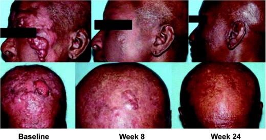 Figure 3. Partial response observed in a patient with tumor stage IVB CTCL. This patient received 6 prior therapies, including total skin electron beam radiation therapy; cyclophosphamide, vincristine, and prednisolone; denileukin diftitox; and bexarotene. This patient was treated with vorinostat 400 mg every day at the time the response was observed. The CTCL lesions were assessed at baseline and visits at week 8 and week 24.