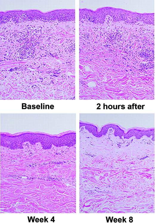 Figure 4. Decreased intensity of dermal lymphocytic infiltrates in paired mycosis fungoides lesions following oral vorinostat treatment: comparison of intensity of lymphocytic infiltrates before and after vorinostat therapy. A decrease in the intensity of the dermal infiltrates was observed after treatment in 9 (39.1%) of 23 sets of lesions after 4 weeks on oral vorinostat therapy. No obvious change in the staining intensity of dermal infiltrates was observed after only 2 hours of treatment.