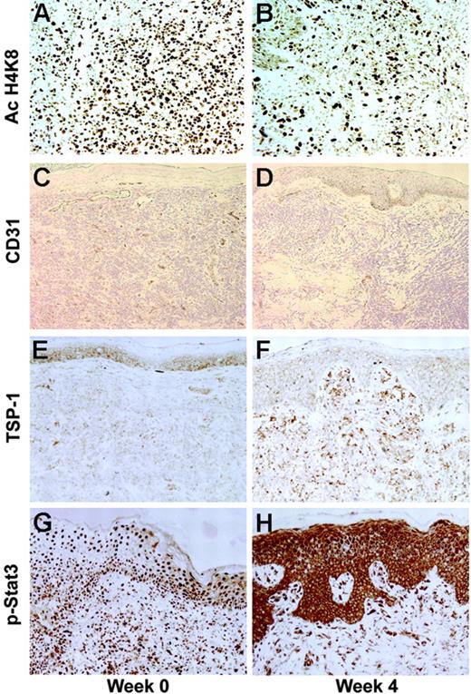 Figure 5. Changes in histone acetylation, microvessel density by CD31+ dermal vessels, thrombospondin-1 (TSP-1) expression, and phospho–STAT-3 (p-STAT-3) localization following 4 weeks of vorinostat treatment. (A) Histone acetylation (Ac H4K8) of keratinocytes and lymphocytes was intense at baseline. (B) After vorinostat treatment, AC H4K8 was less intense because most of the lymphocytes were not present. (C-D) CD31+ dermal vessels were reduced following 4 weeks of therapy in all patients, including responders. (E-F) The antiangiogenic protein TSP-1 was up-regulated following vorinostat treatment, with increased staining in the epidermis and dermal infiltrates. (G-H) p-STAT-3 staining shifted from the nuclei to cytoplasm of keratinocytes and lymphocytes following vorinostat treatment.