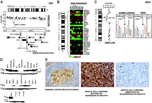 Figure 4. Inactivation of INK4c/P18 in MCL. (A) Array CGH studies and further screen with genomic PCR identified homozygous deletion of INK4c/P18 in 2 MCL cell lines (UPN1 and HBL2) but not in the remaining B-NHL cell lines. (B) Affymetrix oligonucleotide microarrays performed in MCL cell lines of genes located in 1p36-1p32.3 showed absence of CDKN2C expression in both cell lines. (C) Mutation screening identified hemizygous loss and point mutation of INK4c/P18 at a critical splicing site of the remaining allele in JEKO1 cell line, which correlated with absence of P18 expression. (D) Western blot analysis revealed absence of protein expression in these 3 cell lines (UPN1, HBL2, and JEKO1) but also in the majority of other MCL cell lines (JVM2, IRM2) and in patients with MCL (in the figure, lymph node biopsies from patients P1213, P1003, and P7345), whereas INK4c/P18 protein expression was observed in the majority of other B-NHL subtypes. (E) IHC on tissue microarrays revealed absence of expression of INK4c/P18 in MCL with IGH unmutated status.