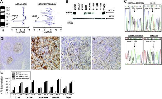 Figure 5. Genomic and proteomic analysis of NOXA in B-NHL. (A) Array CGH analysis of Elijah cells shows homozygous deletion of chromosome band 18q21.3. Within the region, NOXA gene expression shows null expression in the Lymphochip microarrays. (B) Western blot and QRT-PCR analyses show expression variation of NOXA in different B-NHL cell lines; in Elijah, NOXA protein expression is absent according to DNA and RNA data. (C) NOXA gene sequence changes in B-NHL cell lines; the nucleotide positions of NOXA are based on GenBank accession sequence NM_021127. Sequencing analysis of the nondeleted alleles reveals a splice site mutation in Karpas 1106 and a missense mutation in the BH3-domain in Namalwa. (D) Immunohistochemistry analysis for NOXA protein on tissue microarrays from 367 biopsies from patients with different B-NHL. In tonsils, NOXA was shown to be expressed only in a fraction of germinal center B cells, whereas mantle, marginal, and interfollicular lymphocytes were negative (i). In lymphoma samples, NOXA protein expression was restricted to diffuse large B-cell lymphoma (32 of 67, 48%) and in a subset of follicular lymphoma (20 of 103, 19%), whereas MCL, splenic marginal zone lymphoma, and B-cell chronic lymphocytic leukemia samples were mostly negative. In the figure, lymph node biopsies from patients with diffuse large B-cell lymphoma (ii), follicular lymphoma (iii), and splenic marginal zone lymphoma (iv) are shown. (E) Proteasome inhibitor, bortezomib (PS-341) in B-NHL cell lines with and without NOXA mutation. Cell lines were incubated for 24 and 48 hours with increasing concentrations of bortezomib. Apoptosis was calculated by measuring phosphatidylserine (PS) externalization as determined using Annexin V. The results correlated with loss of mitochondrial membrane potential (data not shown). Both the induction and rate of apoptosis were comparable among all the cell lines, irrespective of the presence of genetic alterations in NOXA.