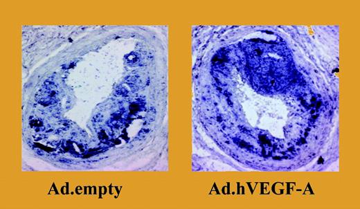 Overexpression of VEGF-A results in a significant increase in plaque size and in a marked accumulation of monocytes. See the complete figure in the article beginning on page 122.