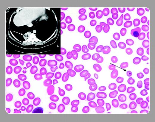 A chest mass was found on a 61-year-old African American male with longstanding anemia. An image from the computed tomography (CT) of the chest is shown as an inset. Prior to a percutaneous fine needle aspiration biopsy (FNA), he was referred for an assessment of his anemia. Hemoglobin level was 92 g/L (9.2 g/dL), mean corpuscular volume, 70 fL; reticulocyte count, 0.049 (4.9%); bilirubin level, 78.7 ümol/L (4.6 mg/dL); haptoglobin level, below 0.1 g/L (below 10 mg/dL); ferritin level, 967 üg/L (967 ng/mL); and soluble transferrin receptor activity (STRA), 65.4 nmol/L. The peripheral smear (main image) showed microcytes, teardrops, a nucleated red cell, and a Howell-Jolly body (arrow). . / Interestingly, the hematologist had seen him 20 years earlier for anemia and an enlarged spleen. At that time, a splenectomy was performed. A decade later, his daughter also had her spleen removed. The current hemoglobin electrophoresis on the gentleman reestablished the original diagnosis of β-δ thalassemia. . / The hematologist suggested that the retrothoracic, extrapulmonary, paravertebral chest mass was most likely extramedullary hematopoiesis and required no treatment. Nonetheless, the referring physician wanted tissue confirmation, which he received when the FNA was performed.