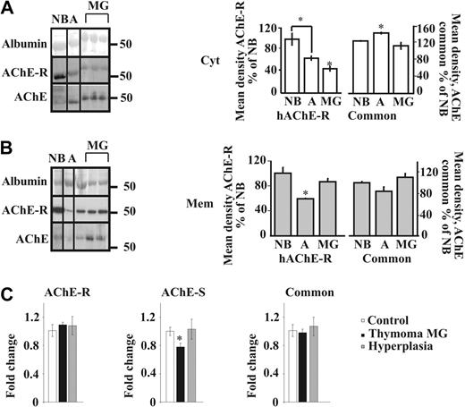 Figure 2. Myasthenic translocation of thymic cytoplasmic AChE-R to the membrane. (A) Immunoblot of individual thymus samples subjected to a single electrophoresis test. Photographs were cropped as marked by the vertical lines. Cytoplasmic AChE (P = .007) and AChE-R (P = .007) decreased in MG patients compared with healthy adults. Cytoplasmic AChE-R decreased in healthy adults compared with newborns (P ≤ .01). (B) Membrane-associated AChE (P = .09) and AChE-R (P ≤ .01) increase in the myasthenic thymus. Membrane-associated AChE-R decreases in healthy adults compared with newborns (P ≤ .02). (C) Real-time RT-PCR on thymus AChE mRNA from thymoma patients with MG wcompared with that of hyperplasia patients and healthy adults. The AChE-S variant was decreased in thymoma patients compared with hyperplasia (P ≤ .02) and healthy adults (P ≤ .012). AChE-R mRNA was increased in thymoma patients with MG compared with the common AChE (P = .06) and AChE-S (P ≤ .02). No changes were seen between the 2 variants in hyperplasia patients and healthy adults. Error bars show standard error of the mean (SEM). *P < .05.