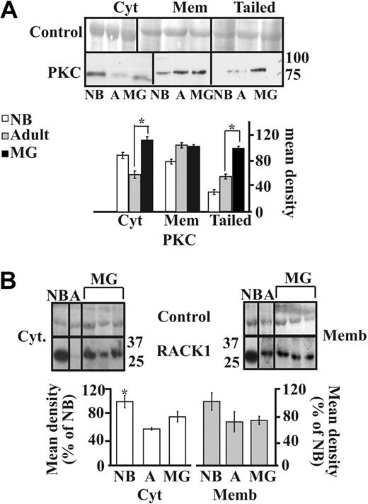 Figure 4. PKC and RACK1 expression in MG thymus. (A) Immunolabeled PKC showed increases in cytoplasmic but not membrane-associated PKC labeling from adults to MG patients (P < .001). Most significant increases occurred in the tailed fraction (healthy adults to MG P < .001). (B) Immunoblot analysis of individual thymus samples subjected to a single electrophoresis run. Photographs were cropped as marked by the vertical lines. Cytoplasmic RACK1 showed a mild increase in MG patients compared with healthy adults and no difference in the membrane-associated RACK1. Error bars show standard error of the mean (SEM). *P < .05.