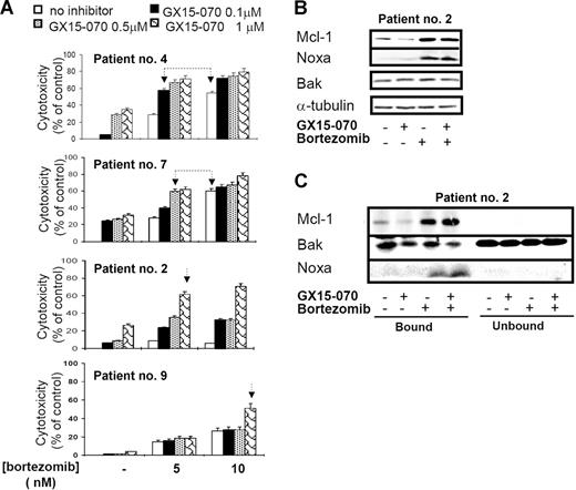 Figure 7. Synergistic interaction between GX15-070 and bortezomib in MCL primary cells. (A) Primary cells from 4 representative patients with MCL were treated with 5 or 10 nM bortezomib and increasing doses of GX15-070 (0.1-1 μM) for 18 hours. Cytotoxicity was evaluated by cytofluorimetric analysis of Annexin V–APC. Linked arrows in patients no. 4 and no. 7 indicate equivalent cytotoxicities. Single arrows in patients no. 2 and no. 9 indicate the sensitizing effect of GX15-070 in these bortezomib-resistant patients. Results represent the mean ± SD of 3 independent experiments (B) Mcl-1, Bak, and Noxa expressions were analyzed by Western blot in 50 μg of total protein extracts from cells of patient no. 2 cotreated with 1 μM GX15-070 and/or 5 nM bortezomib for 18 hours. α-tubulin was also probed as an equal loading control. (C) Cells from patient no. 2 were treated with 1 μM GX15-070 and/or 5 nM bortezomib for 5 hours. Mcl-1, Bak, and Noxa proteins were analyzed in Mcl-1–immunoprecipitated and nonimmunoprecipitated fractions as described in “Patients, materials, and methods.” Western blot images are representative results from 3 independent experiments.