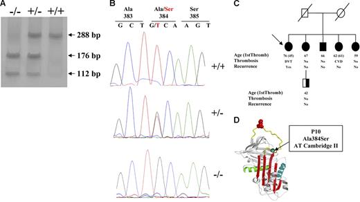 Figure 1. Identification of antithrombin Cambridge II (A384S). (A) PCR-ASRA pattern. (B) Sequence analysis. (C) Pedigree of the family with 5 antithrombin Cambridge II homozygous subjects, with proband identified with an arrow. Type of thrombotic event, age, and recurrence are indicated (NA indicates not available). Filled symbols represent the genetic anomalies identified in this family. (D) Localization of the residue affected by the mutation in the reactive loop (A384S; P10).