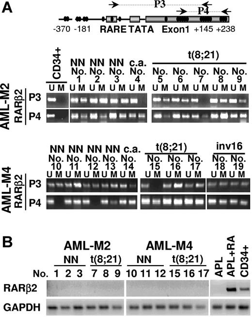 Figure 6. Methylation status of CpGs along the RARβ2 promoter/exon 1 regions in human primary AML blasts. (A) Methylation-sensitive PCR (MSP) assay performed to detect the methylation status of CpGs along the RARβ2 promoter/exon 1 regions on bisulfite-treated genomic DNAs from 19 primary AML blasts at diagnosis (9 cases of AML-M2, 10 cases of AML-M4 according to FAB classification) and CD34+ hematopoietic progenitors obtained from healthy donors. Black arrows in the diagram of RARβ2 promoter/exon 1 region indicate the fragments amplified by the different methylation-sensitive sets of primer pairs (P3 and P4). U and M indicate the unmethylated and methylated forms amplified by methylation-sensitive primer pairs, respectively. The presence of chromosomal translocations is indicated as follows: NN, normal karyotype; c.a., complex aberration. (B) RT-PCR was performed to evaluate the expression levels of RARβ2 mRNA in samples from human AML blasts, normal CD34+ hematopoietic progenitors, and an APL-representative patient treated or not “in vitro” for 48 hours with RA (1 μM). GAPDH expression level was used as internal control to evaluate the amount and the integrity of RNA samples.
