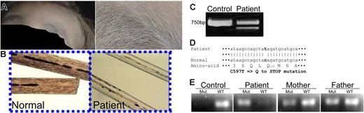 Figure 1. Griscelli patient with a novel RAB27A mutation. (A) The unique silver hair color characteristic of Griscelli syndrome. (B) Dense melanin spots are visible in the colorless hair shaft compared with normal hair. (C) Stop mutation detected in exon 5 of RAB27A. The full ORF was amplified from cDNA. The lower band is a splice variant completely lacking exon 5, resulting in a frameshift downstream. (D) Sequencing revealed a cytidine to thymidine point mutation, changing glutamine 118 into a stop codon. (E) Genomic analysis for the RAB27A mutation. SSP-PCR revealed homozygosity of the mutation of the patient and heterozygosity of the parents. PCR was performed on genomic DNA with primers differing in the single base mutation as described in “Patients, materials, and methods.”