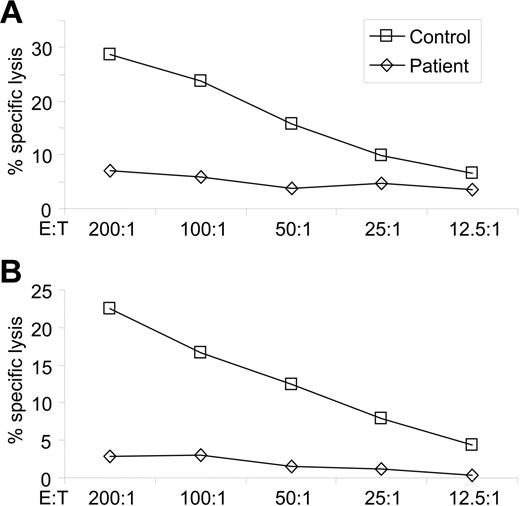 Figure 2. Natural cytotoxicity of the patient is diminished. NK target cells 721.221 (A) or K562 (B) were mixed with PBMCs obtained from the patient or from a healthy donor, at the indicated effector-to-target (E/T) ratios. The target cells were radioactively labeled and specific lysis was calculated. Representative data from 1 of 3 experiments are shown.