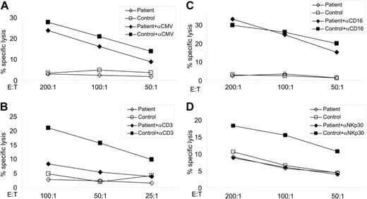 Figure 3. GS patient displays normal ADCC and CD16 activation, but lacks CTL activity or NKp30-dependent lysis. (A) HFFs were infected with CMV and incubated with or without anti-CMV sera. The effector-to-target ratios are indicated. Specific lysis is shown from 1 of 2 experiments performed. (B) P815 target cells were incubated with anti-CD3 mAb to redirect CTL cytotoxicity. Lysis assays were performed as above and the effector-to-target ratios are indicated. One of 2 experiments is shown. (C-D) P815 cells were incubated either with anti-CD16 mAb (C) or with anti-NKp30 (D) to redirect NK cytotoxicity. Effector cells were then added in the indicated E/T ratios. Lysis assays were performed as before. One of 3 experiments is shown.