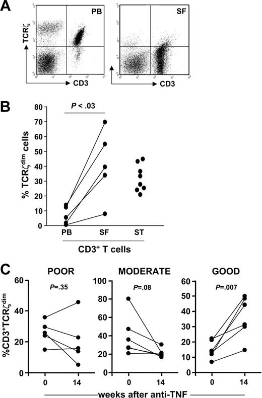 Figure 5. TCRζdim T cells are enriched at sites of inflammation and accumulate in PB after treatment with anti-TNF in a subset of patients. (A) A dot plot of TCRζ versus CD3ϵ expression in PB and SF T cells from a patient with RA, as determined by flow cytometry. (B) Paired PB and SF mononuclear cells from patients with active inflammatory synovitis were stained for TCRζ and analyzed by flow cytometry. Mononuclear cell suspensions were prepared from synovial tissue (ST) specimens obtained from patients with RA at joint arthroplasty. Data are expressed as percent CD3+TCRζdim T cells in each compartment. (C) The percent CD3+TCRζdim cells was determined by flow cytometry in PBLs from 17 patients with RA at baseline and 14 weeks after treatment with anti-TNF. Data were stratified according to EULAR clinical response criteria (poor, moderate, or good), defined at 30 weeks.