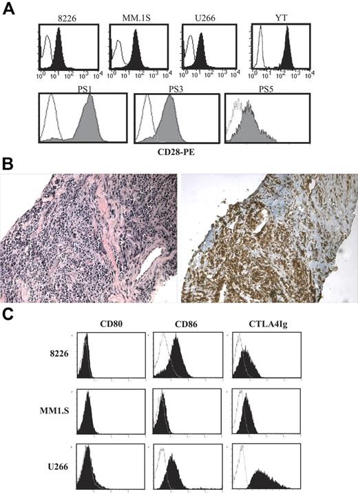 Figure 1. CD28 and CD86 expression. (A) CD28. The indicated cells were stained with anti-CD28 PE (filled histogram) or isotype control (open histogram) and analyzed by FACS. Top panels show cell lines. Bottom panels show primary myeloma isolates. Primary myeloma cells were purifed from 3 different patient samples (PS; bone marrow aspirates, recurring MM) by CD138 immunomagnetic selection. (B) Extramedullary plasmacytoma. Serial sections from an extramedullary plasmacytoma were stained with hematoxylin/eosin (left panel) or anti–human CD28 (brown staining, right panel). Magnification, 20×/0.40 NA N Plan objective. Representative sections from 1 of 2 patients with intramuscular extramedullary plasmacytomas. (C) CD80 and CD86. The cell lines indicated were stained with isotype control (open histograms), anti-CD80, CD86 mAb, or CTLA4-Ig (closed histograms), and analyzed by FACS. Data are representative of 2 independent experiments.