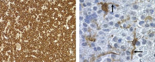 Figure 6. DCs physically interact with myeloma cells. Bone marrow biopsy from patient 88 with recurring MM was stained for CD138 for myeloma cells (brown-staining cells; left panel; magnification, 40×/0.55 NA N PLAN objective) or fascin for DCs (brown-staining cells; right panel; magnification, 100×/1.4 NA oil objective). Photomicrograph of fascin+ cells was taken from a region in the center of the field shown in the left panel. Arrows point to interdigitating DC dendrites.