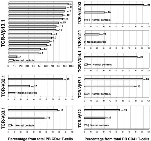 Figure 2. Illustrative representation of the size of the actual identifiable TCR-Vβ expansion present in each patient (as percentage of total PB CD4+ T cells) in comparison with the size of the corresponding TCR-Vβ family observed in a cohort of age-matched healthy subjects (n = 15). Gray bars correspond to patients, each one identified by the corresponding case number, while white bars and horizontal lines correspond to the mean value and 1 SD found in healthy controls, respectively.