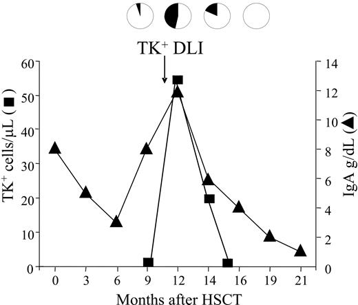 Figure 3. Kinetics of disease response in a patient with multiple myeloma following TK+ DLI. Patient 17 affected by IgA-secreting multiple myeloma was treated with a single infusion of TK+ DLI. Absolute numbers of circulating TK+ cells, quantified by FACS analysis, are shown as ■. Percentage of malignant cells in the bone marrow (black sectors of pies) was assessed by quantification of monoclonal plasma cells in the bone marrow. Disease status was also monitored by the levels of serum monoclonal IgA (▴) and confirmed by IgAκ immunofixation (not shown). Clearance of all parameters of disease closely followed the peak of circulating TK+ cells.