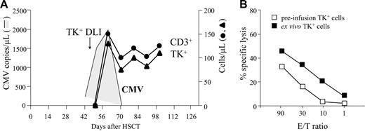 Figure 4. Reconstitution of anti-CMV protective immunity by TK+ DLI. (A) Patient 12 experienced a CMV reactivation syndrome with high titers of viremia, as detected by quantitative PCR (shaded area). TK+ DLI was followed by a rapid expansion of gene-modified cells, as measured by FACS analysis for ΔLNGFR expression, which peaked at 115 cells/μL after 20 days. At this time point nearly all circulating CD3+ cells (●) were TK+ (▴). Concomitantly, CMV viremia dropped and all clinical signs of CMV disease disappeared. (B) At a time corresponding to the peak of TK+ cells in the circulation, PBMCs were harvested (■) and stimulated with irradiated autologous PBMCs pulsed with the CMV-immunodominant pp65495-503 peptide. For comparison, a sample of preinfusion TK+ cells (□) was also stimulated and tested. After 7 days, specific lysis of the 2 effector populations was measured against HLA-A0201+ T2 cells pulsed with the pp65495-503 peptide in a chromium-release assay. No lysis of unpulsed T2 cells was observed.