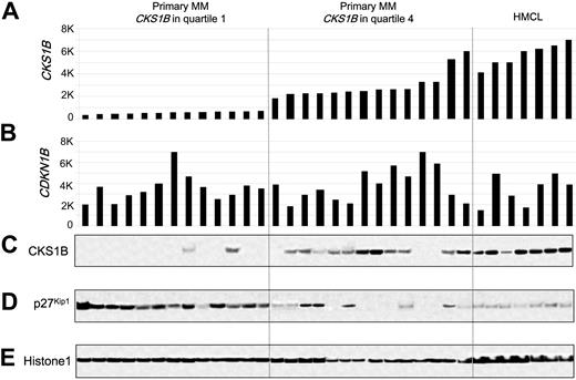 Figure 1. CKS1B mRNA and protein expression are inversely correlated with p27Kip1 protein levels in primary disease. (A) CKS1B and (B) CDKN1B (p27Kip1) gene expression signal in 1000-unit increments is plotted on the y-axis. Primary myeloma with CKS1B expression in quartile 1 (n = 13) and quartile 4 (n = 14) and MM cell lines (n = 7) are grouped and plotted from left to right along the x-axis. Each bar represents a sample, and the height indicates the level of gene expression in each sample. (C) CKS1B, (D) p27Kip1, and (E) Histone 1 levels were evaluated by Western blot analysis of nuclear fractions derived from the same aliquots of plasma cells used in panels A-B. Samples are ordered from left to right in the exact same order in all panels.