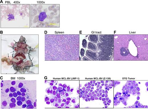 Figure 1. Clinical appearance of tumors in DTG mice. (A) Peripheral-blood smear from a 3-week-old DTG mouse showing leukemic atypical large blastic lymphoid cells morphologically similar to lymphomas subsequently arising in peripheral lymphoid tissues (original magnifications: left, ×400, right, ×1000). (B) Gross necropsy photo of DTG mouse, showing widespread and extensive peripheral lymphadenopathy indicative of lymphomatous involvement as histologically shown in panel D. Arrows indicate lymph nodes. (C) Bone marrow from a 3-month-old DTG mouse showing large “blastoid” lymphoma cells (original magnification, ×1000). (D) Histopathologic H&E-stained paraffin section of the spleen showing diffuse effacement of an enlarged lymph node diffusely replaced with large “blastoid” lymphoma cells with admixed large “pink” histiocytes characteristic of MCL-BV (original magnification, ×400). (E) Lymphomatous involvement in the gastrointestinal tract showing diffuse involvement of the lamina propria and submucosa (original magnification, ×400). (F) Liver involvement in DTG mice, showing perivascular infiltrates of lymphoma cells (original magnification, ×400). (G) Comparison of DTG lymphoma cell line with 2 representative MCL-BV cell lines from patients showing morphologic similarity between human MCL-BV and the DTG murine model (H&E; original magnification, ×1000).