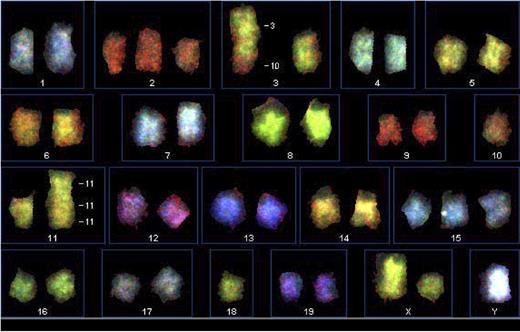 Figure 4. Spectral karyotyping (SKY) of a DTG cell line. SKY was performed as outlined in “Patients, materials, and methods.” A 3:10 translocation, trisomy 15, trisomy 2, and 11:11 translocation were observed.