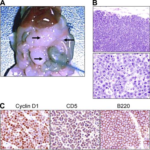 Figure 6. Transplantation of DTG lymphoma cells into immune-deficient SCID mice. (A) Necropsy of a SCID mouse that received a transplant of cells from a cell line derived from a DTG mouse lymphoma (arrows). (B) H&E paraffin sections of the SCID peritoneal tumor bearing the DTG tumor cells from low (top panel; original magnification, ×100) to high magnification (bottom panel, original magnification, ×400). (C) Immunohistochemical analysis of the transplanted lymphoma from a SCID mouse showing the expression of cyclin D1, CD5, and B220 (original magnification, ×400).