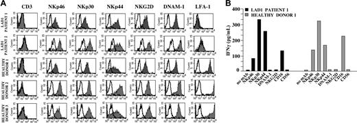 Figure 1. Surface expression of the major triggering receptors and IFN-γ release by LAD1 NK cells. (A) IL-2–activated NK cell populations from LAD1 patients and from representative age-matched healthy donors were stained with monoclonal antibodies specific for the indicated molecules followed by PE-conjugated goat anti–mouse isotype-specific secondary reagent and analyzed by flow cytometry. NK cells represented virtually all purified cells as demonstrated by the homogeneous expression on viable cells of different NK markers including the NK-restricted NCR. White profiles indicate cells incubated with the secondary reagent only. (B) IL-2–activated NK cell populations from LAD1 patient 1 or the representative age-matched healthy donor 1 were stimulated with plate-bound mAbs specific for the indicated molecules. After 24 hours of culture, IFN-γ production was assessed by ELISA. Data represent the mean of 5 independent experiments (standard deviation < 5%).