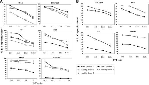 Figure 3. Comparison between natural cytotoxicity mediated by IL-2–activated LAD1 NK cells and normal NK cells against human tumor cell targets. IL-2–activated NK cell populations derived from LAD1 patient 1 (A), LAD1 patient 2 (B), and the representative age-matched healthy donors were analyzed for cytolytic activity against the indicated (FcγR-negative) target cell lines at different E/T ratios. Target cells are of human origin with the exception of murine BW5147 cells. The results are representative of 3 independent experiments; the standard deviation of the mean of the triplicates was less than 5%. Kruskal-Wallis test and Mann-Whitney test were used for statistical analyses of the data showed in panel A and B, respectively.