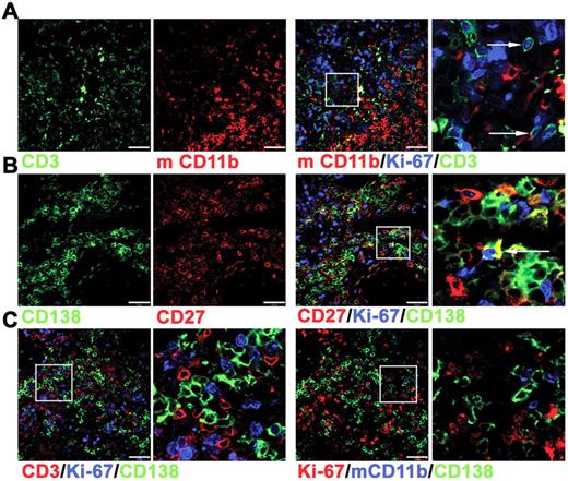 Figure 2. Immunofluorescence analysis of cells within tonsil grafts. Immunofluorescence was used to assess coexpression of multiple markers by the cells within tonsil grafts recovered at 4 weeks after surgery. (A) Three-color staining to detect expression of human CD3 (green), Ki-67 (blue), and mouse (m) CD11b (red). Enlarged view of cells expressing both Ki-67 and CD3 indicated by arrows (far right panel). (B) Three-color staining to detect expression of human CD138 (green), Ki-67 (blue), and human CD27 (red). Enlarged view of cells expressing both Ki-67 and CD138 indicated by arrow (far right panel). (C) Four-color staining (with only 3 of these shown in a given panel) to detect expression of human CD3 (red), human CD138 (green), Ki-67 (blue) in the left 2 panels and human CD138 (green), Ki-67 (red), and mCD11b (blue) in the right 2 panels. Right panel of each pair shows enlarged image. Scale bar represents 50 μm. Staining is representative of 5 tonsil grafts from each of 3 different grafting experiments.