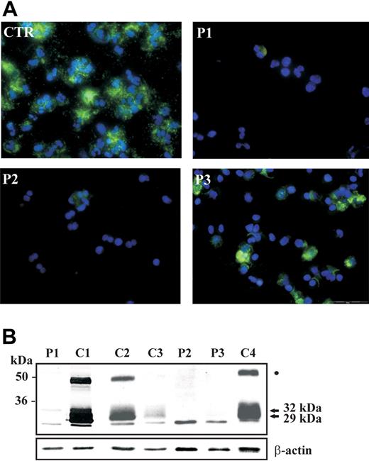 Figure 1. Abnormal expression of neutrophil elastase in neutrophils of SCN patients during treatment with G-CSF. (A) Immunofluorescence staining of NE in circulating neutrophils from SCN patients. Polymorphonuclear lymphocytes (PMNs) were obtained from peripheral blood, cytocentrifugated, and stained with anti-NE antibody; nuclei were counterstained with DAPI. The majority of cells from a control subject (CTR) show a strong cytoplasmatic expression of NE, whereas NE is detectable in a minority of cells obtained from patients 1, 2, and 3. Experiment shown is representative of 2 performed. (B) Cell lysates of neutrophils purified from 3 patients (P1, P2, and P3), 2 healthy control subjects (C1, C2), and 2 idiopathic neutropenia patients (C3 and C4) were subjected to Western blot analysis with anti–neutrophil elastase antibody. β-Actin was used to normalize protein levels. The 29- and 32-kDa polypeptides are indicated by arrows. The band indicated by a dot could correspond to the previously identified elastase-alpha1 antitrypsin complex.21