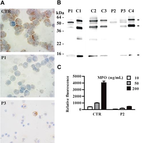 Figure 2. Abnormal expression of myeloperoxidase in neutrophils of SCN patients during treatment with G-CSF. (A) Immunocytochemical staining of MPO in circulating neutrophils from SCN patients. PMNs were obtained from peripheral blood, cytocentrifugated, and stained with anti-MPO antibody; nuclei were counterstained with Mayer hematoxylin. In cells from a control subject (CTR), a strong granular expression of MPO is observed in the cytoplasm. In contrast, MPO is detectable in a minority of cells obtained from patient 3 (P3) and undetectable in cells from patient 1 (P1). (B) The Western blot shown in Figure 1B has been reprobed with specific antimyeloperoxidase antibody. The 3 myeloperoxidase bands are indicated by arrows. (C) MPO chlorination activity in neutrophil cell lysates (3 dilutions of each sample) from a healthy subject (CTR) and patient 2 (P2) was analyzed by EnzChek Myeloperoxidase (MPO) Activity Assay Kit (“Patients, materials, and methods”). Results are expressed as relative fluorescence and are shown as mean values ± SD of 3 experiments. Statistical analysis demonstrates that the chlorination activity in neutrophil cell lysates is lower in SCN patients compared with healthy subjects (P < .05).
