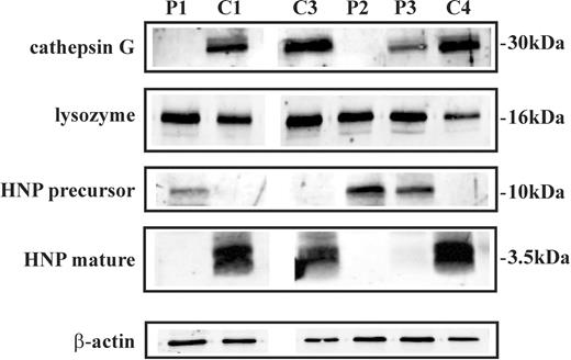 Figure 4. Expression of cathepsin G, lysozyme, and HNP in neutrophils of SCN patients during treatment with G-CSF. Cell lysates of neutrophils purified from patients 1, 2, and 3 (P1, P2, and P3), a healthy control subject (C1), and 2 idiopathic neutropenia patients (C3 and C4) were subjected to Western blot analysis with antibodies raised against neutrophil cathepsin G, lysozyme, HNP precursor, and HNP mature protein. β-Actin was used to normalize protein levels.
