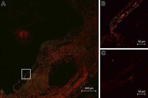 Figure 5. PCI and annexin V are colocalized in atherosclerotic plaques. Cryosections of atherosclerotic plaques were prepared and stained for PCI (monoclonal anti–PCI IgG and Alexa Fluor 568 goat anti–mouse IgG, red) and annexin V (rabbit anti–annexin V IgG and Alexa Fluor 488 goat anti–rabbit IgG, green) as described in “Materials and methods.” Sections were analyzed by confocal laser scanning microscopy. Yellow color indicates colocalization of PCI (red) and annexin V (green). (A) Atherosclerotic plaque type IV-Va, overview; (B) detail corresponding to the framed area in panel A; (C) control without first antibody, same detail as in panel B.