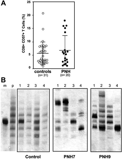 Figure 1. Analysis of circulating CD8+ CD57+ T cells in PNH patients and in healthy controls. (A) Quantitation of CD8+ CD57+ T cells. Percentage of CD8+ CD57+ T cells within peripheral blood mononuclear cells (PBMNCs). Each circle represents 1 control subject or 1 PNH patient. Average and standard deviation are shown for the patient group and for the control group (P = .38). (B) Size distribution of the CDR3 region of the TCRB genes within the CD8+ CD57+ cell population of individual subjects. Each 4-lane panel displays the analysis, by electrophoresis on a denaturing polyacrylamide gel, of the products of 4 multiplex PCRs (lanes 1 to 4) designed to detect all possible TCRB gene rearrangements that can take place in T cells. After silver staining, each lane shows a ladder of bands differing from each other by 3 bp or a multiple of 3 bp. The 2 left lanes are for reference: lane m shows the product of the amplification, obtained with the appropriate primers, of the TCR-β CDR3 from a monoclonal population of T cells (from a patient with a T-cell leukemia); lane p shows the product of the amplification, with 1 of the 4 sets of primers, of the TCR-β CDR3 from a polyclonal T-cell population (from a healthy person). The panel labeled “control” shows, in a healthy subject, a gaussian distribution of CDR3 sizes in each of the 4 lanes. The next 2 panels illustrate the results in 2 PNH patients (Table 1). In patient PNH 7, one sees nongaussian distributions of CDR3 sizes in all 4 lanes, with 1 band predominating in each of the 4 lanes. In patient PNH 9, there is only 1 heavy band in lane 4, and in the other 3 lanes the distributions are also markedly skewed.