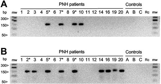 Figure 3. Clonotype-specific PCR amplification. Seminested PCR was carried out with clonotype-specific primers that, because they do not overlap the entire V-nDn-J junctions, enable the amplification of either identical or quasi-identical CDR3 sequences. Numbers identify PNH patients as from Table 1. Capital letters indicate healthy controls; *, patients in whom the clonotype had been previously identified by systematic cloning and sequencing; mw, molecular weight markers; rc, reagent control. (A) Clonotype-specific PCR for S4 clonotype. A specific S4 clonotype band is present in the 3 patients in whom it had been previously found by systematic cloning and sequencing (PNH 5, 7, 9; Table 2) and in 1 additional patient (PNH 10). The sequencing of the amplified products confirmed the identity of the sequence. (B) Clonotype-specific PCR for S5-like clonotype. A specific S5-like clonotype band is present in the 4 patients in whom it had been previously found by systematic cloning and sequencing (PNH 2, 5, 7, 9; Table 2) and in 4 additional patients (PNH 3, 14, 16, 20). The sequencing of the amplified products demonstrates the presence of both S5-identical and S5 quasi-identical sequences (Table 3). In addition, the PCR amplification in patient 19 yielded a longer PCR product whose sequence (CATSRGTSGRETQYFGP) revealed a CDR3 that uses the same TRBV-15 and TRBJ-2.5 of S5-like clonotypes but with a 6 nucleotide insertion that modifies significantly the nDn region. Therefore, this sequence has not been counted as belonging to the S5-like clonotype group.