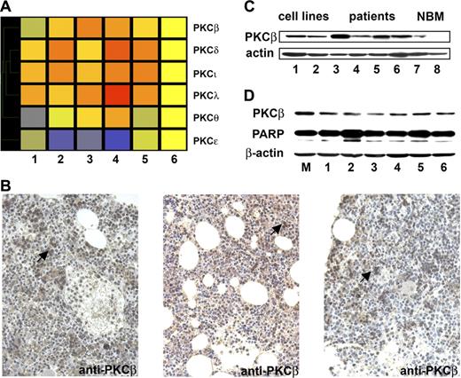 Figure 1. PKCβ is elevated in patients with WM and is essential for the survival of WM cells. (A) Proteomic analysis of some PKC protein family members: the WM samples are numbered 1 to 5. The control sample (composed of 3 control samples mixed) is at the far right of the heat map. All the samples were normalized to the control sample using the Genespring software. The data points are colored by expression with lower signal values colored blue and higher values, red. Yellow signifies expression values equal to the control sample. (B) Immunohistochemistry with anti-PKCβ on patient's bone marrow biopsy demonstrating increased staining in the WM samples 2, 3, and 4 of the protein microarrays. The arrows indicate some examples of PKCβ-positive cells. (C) Whole-cell lysates from BCWM.1 (1), MEC1 (2), as well as 4 patients' bone marrow samples CD19+ selected (3 to 6) and 2 healthy donors' bone marrows CD19+ selected (7 and 8) were subjected to Western blotting using anti-PKCβ antibody. β-Actin was used as control. PKCβ was overexpressed in WM samples compared to control. (D) BCWM.1 cells were transduced with 6 different shRNAs (1 to 6) or mock (M) using a lentivirus transfection system. At 48 hours after transduction, whole-cell lysates were subjected to Western blotting using anti-PKCβ, anti-PARP, and anti–β-actin antibodies.