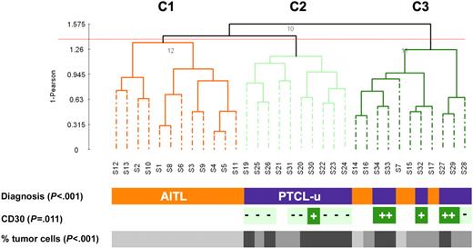 Figure 1. Unsupervised clustering of 16 PTCL-u and 17 AITL tissue samples. Dendrogram of the 33 lymphoma tissue samples based on PCA of the first 25 components (accumulated variance 95%). CD30: + denotes expression in more than 50% of neoplastic cells; - denotes absence of expression or low level of expression of CD30 in neoplastic cells. The percentage of tumor cells is represented by a gray scale (light gray: 30%-50% tumor cells; medium gray: 50%-70% tumor cells; and dark gray: > 70% tumor cells).