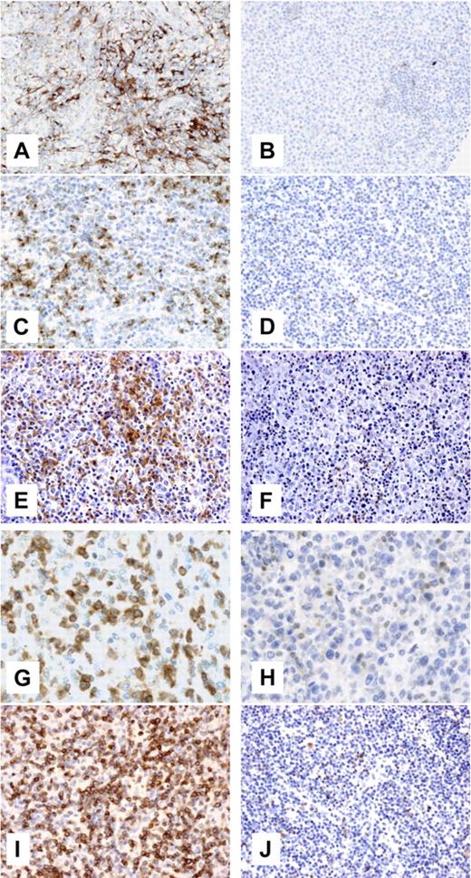 Figure 3. Clusterin, CXCL13, PDCD1, NFTAC1, and CD27 immunohistochemistry in AITL and PTCL-u. Representative AITLs (A, C, E, G, and I) and PTCLs-u (B, D, F, H, and J) were immunostained for clusterin (A-B, original magnification ×200, Zeiss Axioscope; Carl Zeiss, Heidelberg, Germany), CXCL13 (C-D, original magnification ×200, Zeiss Axioscope), PDCD1 (E-F, original magnification ×200, Nikon Eclipse 80i; Nikon, Tokyo, Japan), NFATC1 (G-H, original magnification ×400, Zeiss Axioscope), and CD27 (I-J, original magnification ×200, Nikon Eclipse 80i). For panels A-D and G-H, photographs were taken with a DP70 Olympus camera (Tokyo, Japan); images were acquired using DP Controller 2002 (Olympus) and processed using Adobe Photoshop v7.0 (Adobe Systems, San Jose, CA). For panels E-F and I-J, photographs were taken with a CFW-1310C camera (Scion, Frederick, MD); images were acquired using Histolab 5.131.1 (Alphelys, Plaisir, France) and processed using Adobe Photoshop v7.0. Objectives used were Nikon Plan Fluor 20×/0.50 NA; Zeiss Plan Neufluor 20×/0.40 NA; and Zeiss Plan Neofluor 40×/0.60 NA.